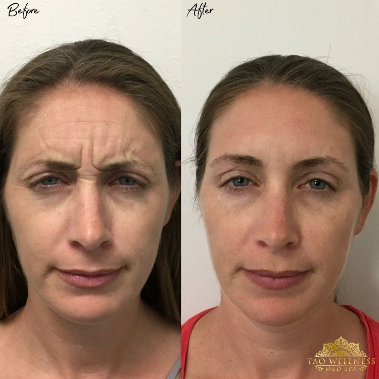 before and after botox treatment at tao wellness medspa ()